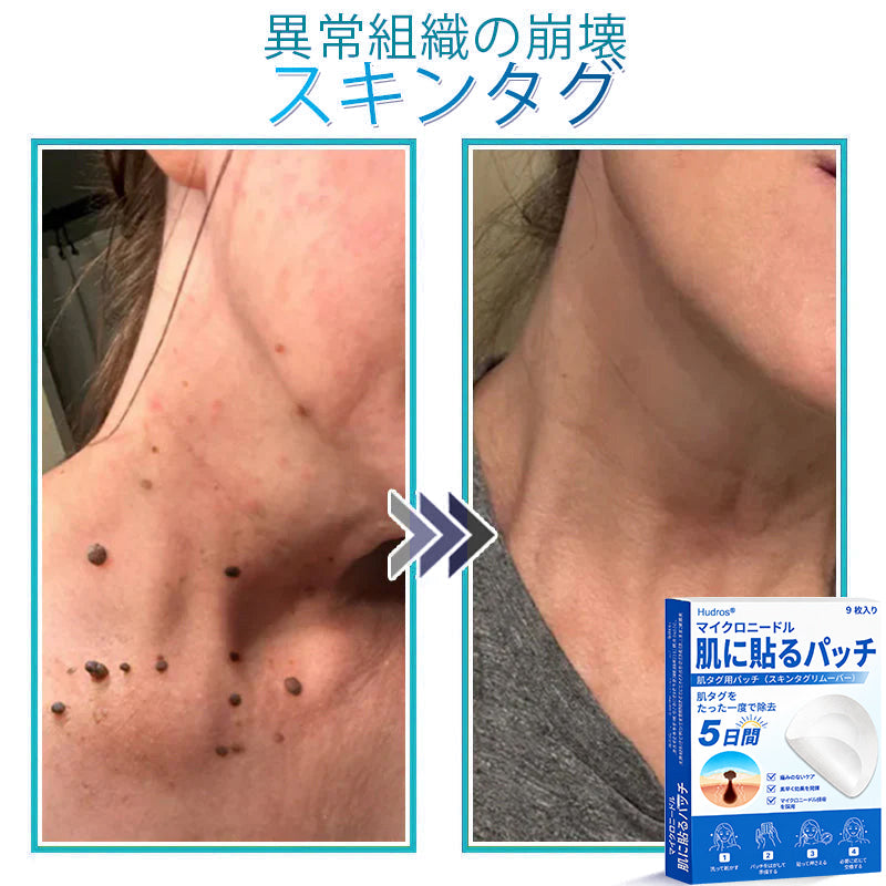 𝐇𝐮𝐝𝐫𝐨𝐬® 📌 𝟐-𝐢𝐧-𝟏 ハイドロコロイドマイクロニードルパッチ｜盛り上がったほくろ、ニキビ、平らなイボおよび皮膚の突起の除去用に特別設計｜9枚入りパッケージ🌱🌱