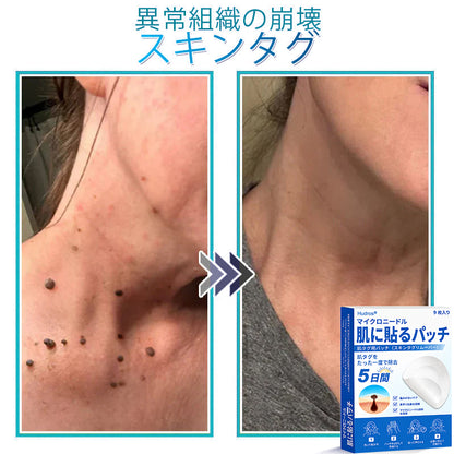 𝐇𝐮𝐝𝐫𝐨𝐬® 📌 𝟐-𝐢𝐧-𝟏 ハイドロコロイドマイクロニードルパッチ｜盛り上がったほくろ、ニキビ、平らなイボおよび皮膚の突起の除去用に特別設計｜9枚入りパッケージ🌱🌱