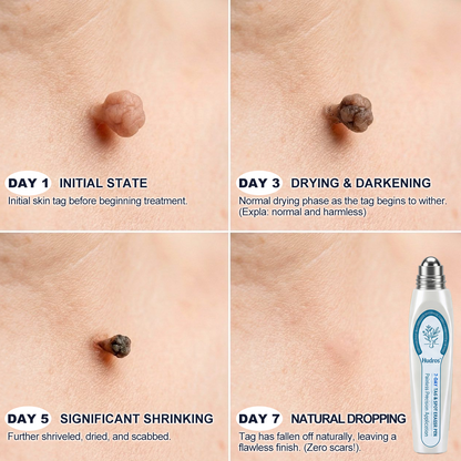 𝐇e𝐚𝐥𝐫i𝐳e® 7-𝐷𝑎𝑦 𝗧𝐚𝐠 & 𝗦𝗽𝐨𝐭 𝐄𝐫𝒂𝒔𝒆𝒓(Zero Pain, Zero 𝐒𝐜𝐚𝒓𝒔 Rollerball) 🚚