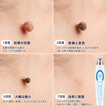 Healrize® 7日間 シミ・ほくろケアリムーバー（痛みなし・跡が残りにくい ロールボールアプリケーター付き）🦨🦡1