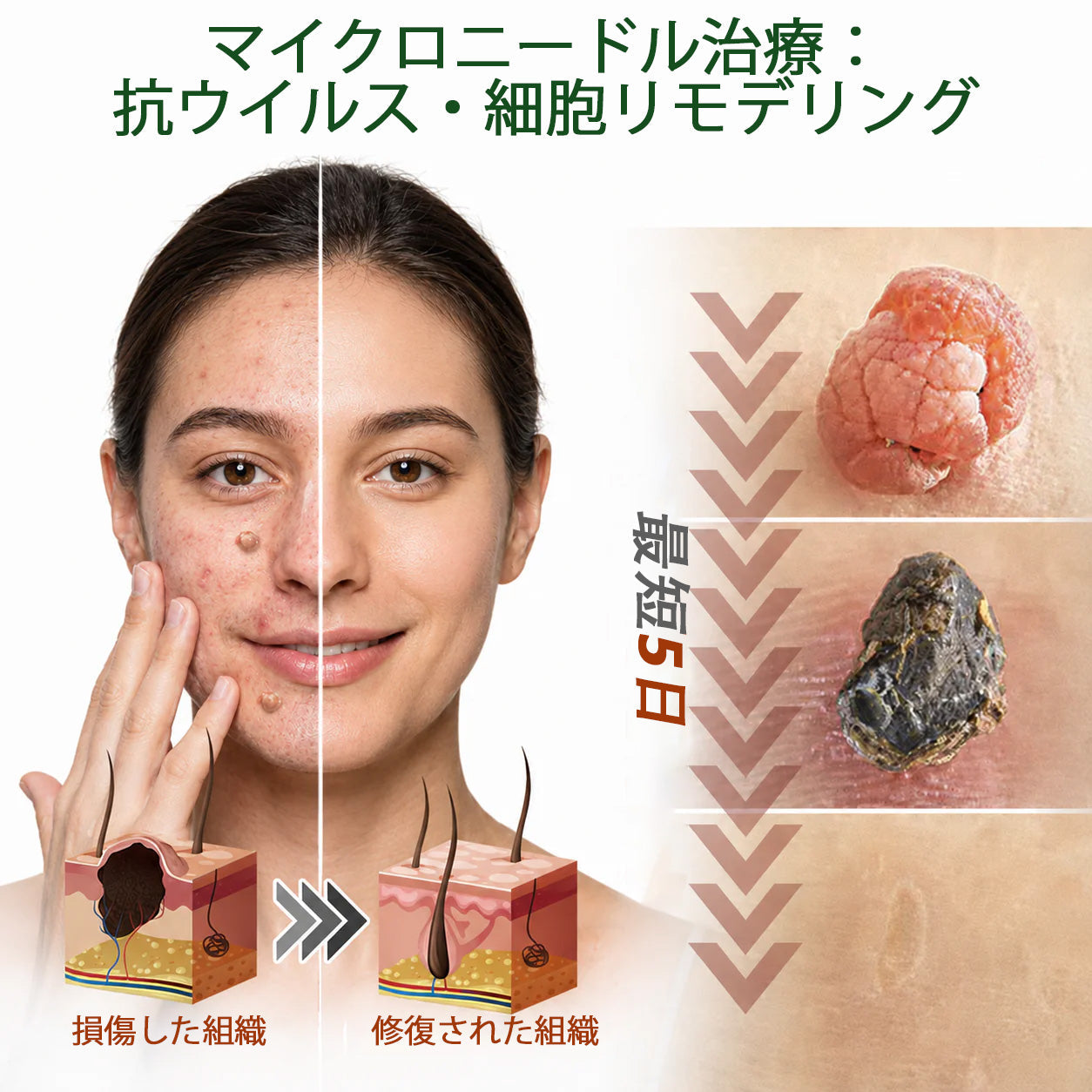 𝐇𝐮𝐝𝐫𝐨𝐬® 📌 𝟐-𝐢𝐧-𝟏 ハイドロコロイドマイクロニードルパッチ｜盛り上がったほくろ、ニキビ、平らなイボおよび皮膚の突起の除去用に特別設計｜9枚入りパッケージ🌱🌱