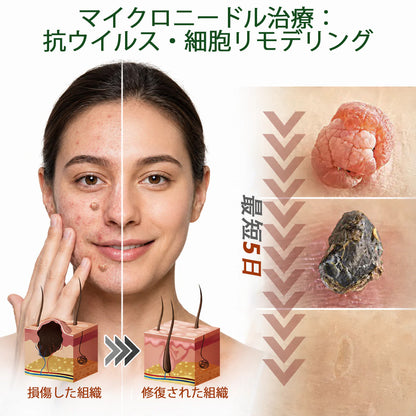 𝐇𝐮𝐝𝐫𝐨𝐬® 📌 𝟐-𝐢𝐧-𝟏 ハイドロコロイドマイクロニードルパッチ｜盛り上がったほくろ、ニキビ、平らなイボおよび皮膚の突起の除去用に特別設計｜9枚入りパッケージ🌱🌱