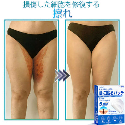 𝐇𝐮𝐝𝐫𝐨𝐬® 📌 𝟐-𝐢𝐧-𝟏 ハイドロコロイドマイクロニードルパッチ｜盛り上がったほくろ、ニキビ、平らなイボおよび皮膚の突起の除去用に特別設計｜9枚入りパッケージ🌱🌱