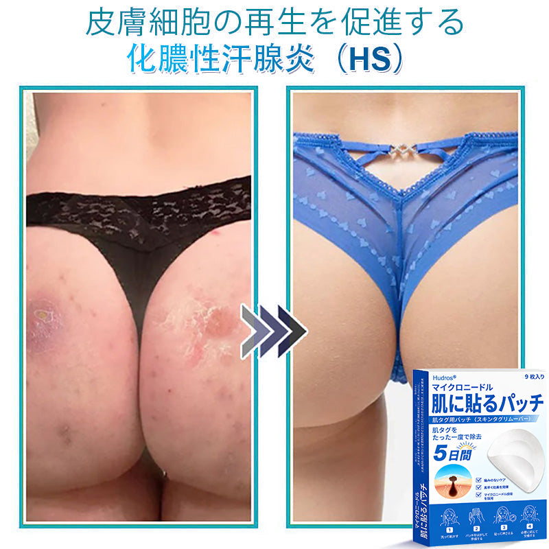 𝐇𝐮𝐝𝐫𝐨𝐬® 📌 𝟐-𝐢𝐧-𝟏 ハイドロコロイドマイクロニードルパッチ｜盛り上がったほくろ、ニキビ、平らなイボおよび皮膚の突起の除去用に特別設計｜9枚入りパッケージ🌱🌱