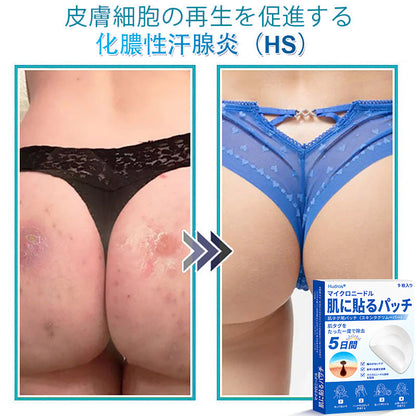 𝐇𝐮𝐝𝐫𝐨𝐬® 📌 𝟐-𝐢𝐧-𝟏 ハイドロコロイドマイクロニードルパッチ｜盛り上がったほくろ、ニキビ、平らなイボおよび皮膚の突起の除去用に特別設計｜9枚入りパッケージ🌱🌱