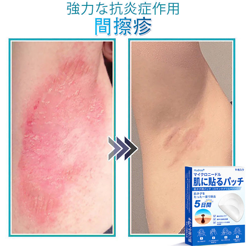𝐇𝐮𝐝𝐫𝐨𝐬® 📌 𝟐-𝐢𝐧-𝟏 ハイドロコロイドマイクロニードルパッチ｜盛り上がったほくろ、ニキビ、平らなイボおよび皮膚の突起の除去用に特別設計｜9枚入りパッケージ🌱🌱