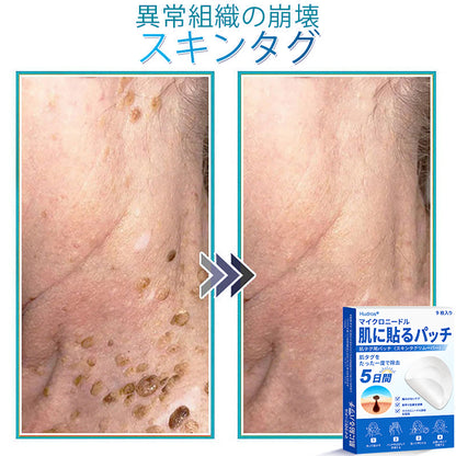 𝐇𝐮𝐝𝐫𝐨𝐬® 📌 𝟐-𝐢𝐧-𝟏 ハイドロコロイドマイクロニードルパッチ｜盛り上がったほくろ、ニキビ、平らなイボおよび皮膚の突起の除去用に特別設計｜9枚入りパッケージ🌱🌱