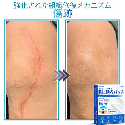 𝐇𝐮𝐝𝐫𝐨𝐬® 📌 𝟐-𝐢𝐧-𝟏 ハイドロコロイドマイクロニードルパッチ｜盛り上がったほくろ、ニキビ、平らなイボおよび皮膚の突起の除去用に特別設計｜9枚入りパッケージ🌱🌱