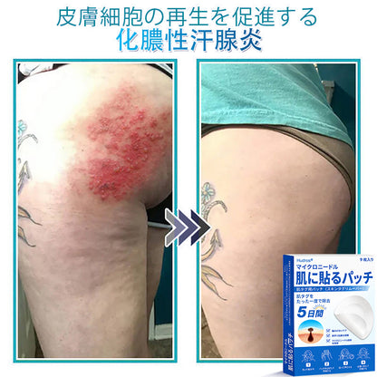 𝐇𝐮𝐝𝐫𝐨𝐬® 📌 𝟐-𝐢𝐧-𝟏 ハイドロコロイドマイクロニードルパッチ｜盛り上がったほくろ、ニキビ、平らなイボおよび皮膚の突起の除去用に特別設計｜9枚入りパッケージ🌱🌱